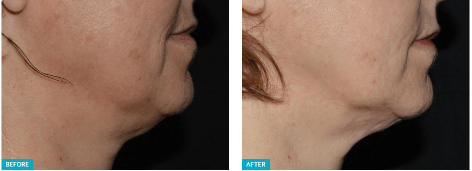 Best Skin Tightening Firming Treatment In Nj And Nyc